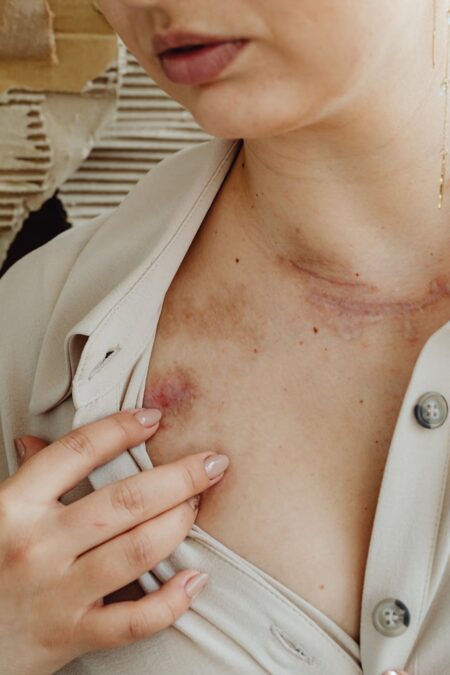 close up of woman showing her scars and bruises on her neck and chest